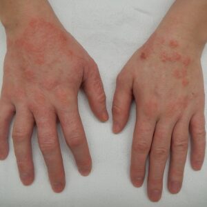 Eczema