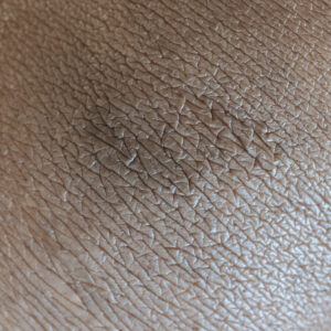 Pigmentation